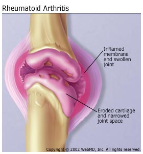 arthritis joint inflammation